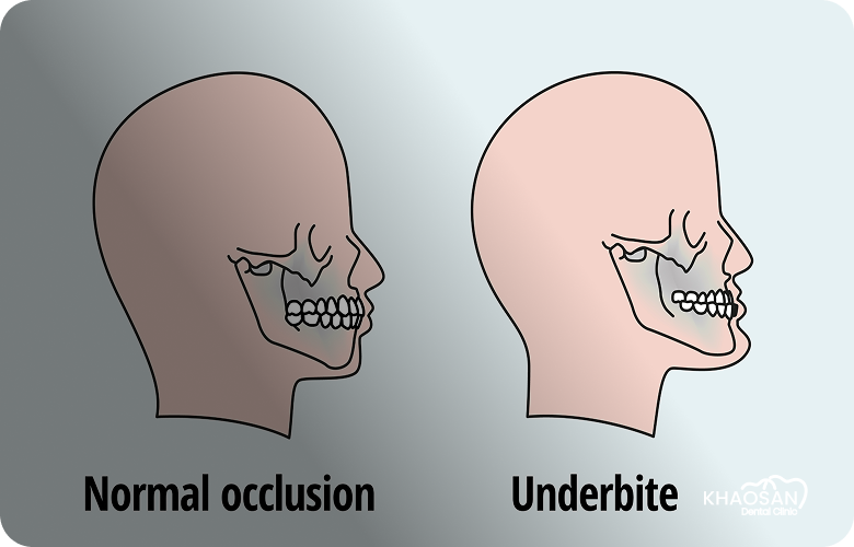 Bone Grafting & Sinus Lift khaosan