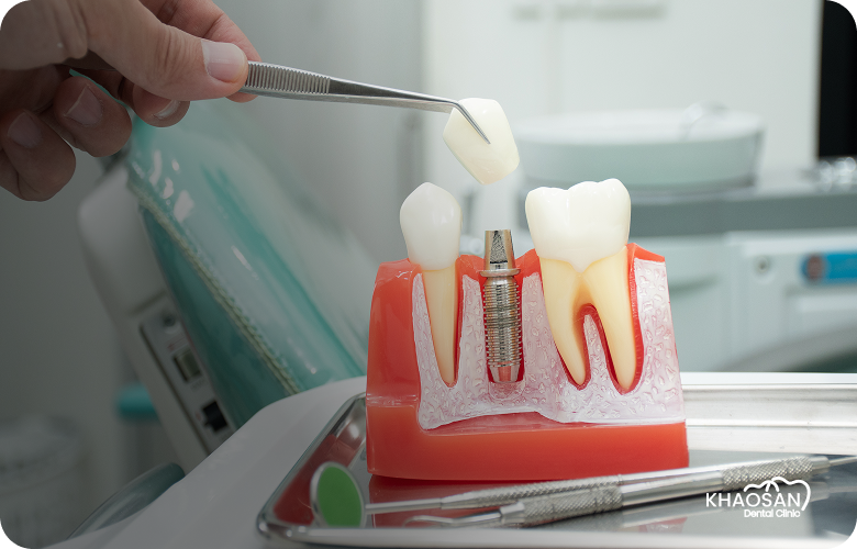 Dental Implants khaosan