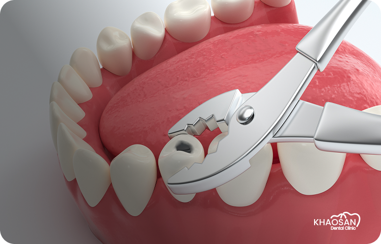 Extraction & Oral Surgery khaosan