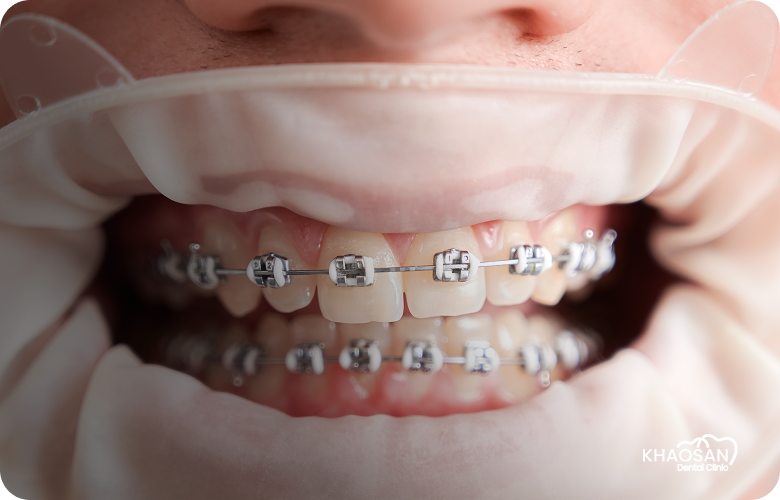 Metal Braces khonsan