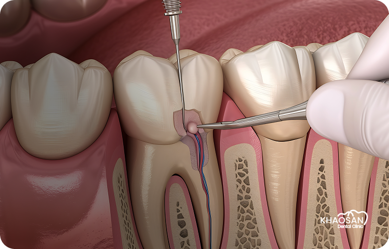 Root Canal Treatment khaosan